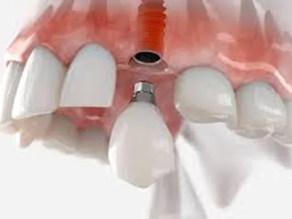Restoring Your Smile: What I Learned About Dental Implants